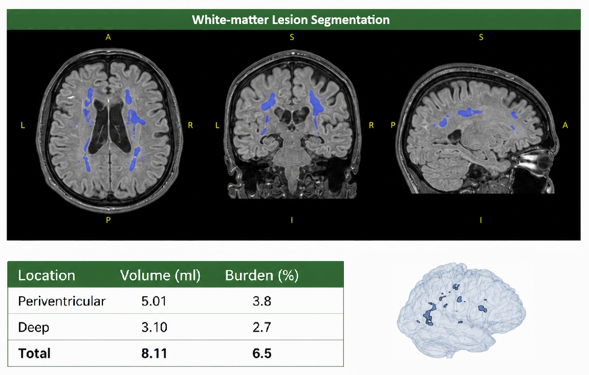 White-matter lesion segmentation report